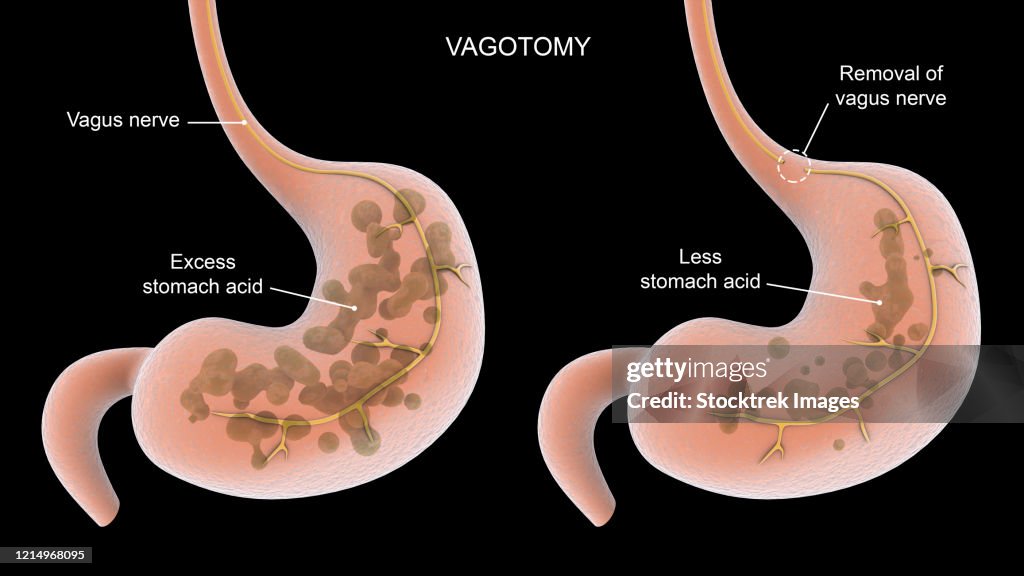 Vagotomy surgical procedure to remove part of the vagus nerve.