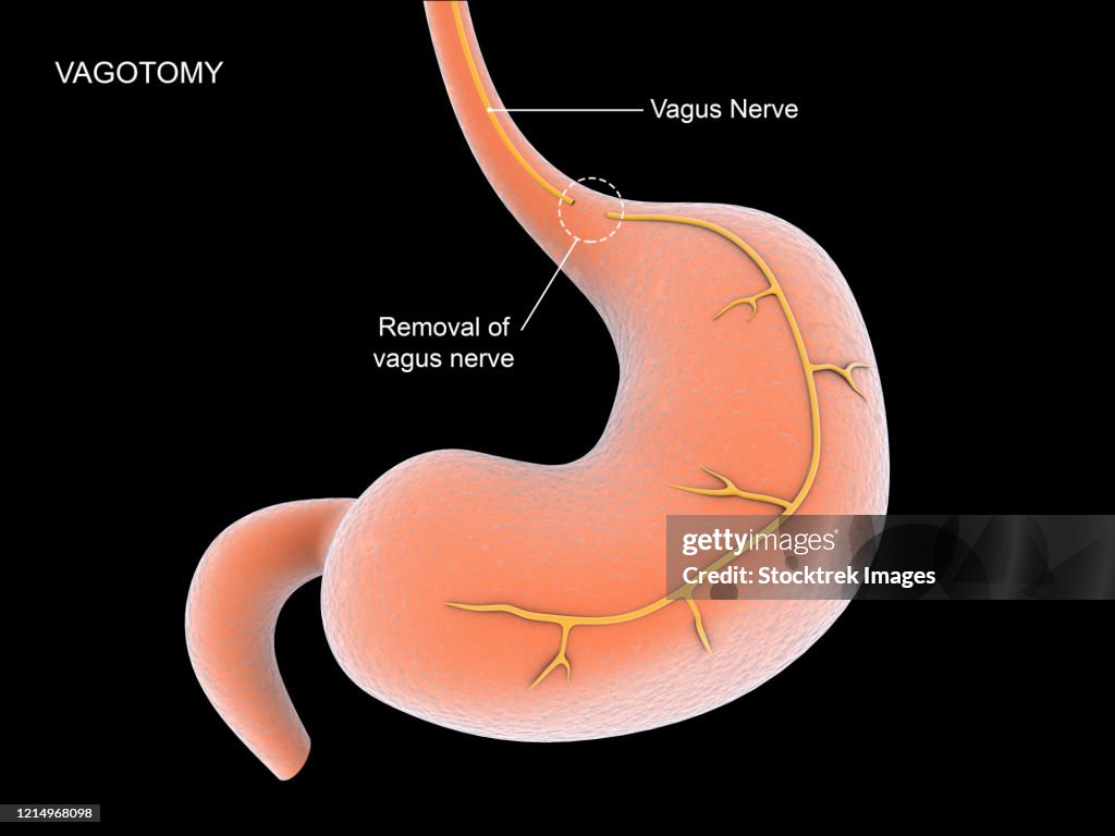 Vagotomy surgical procedure to remove part of the vagus nerve.
