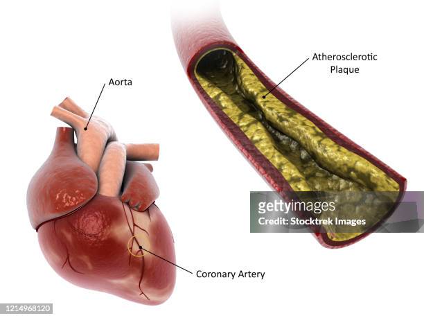 atherosclerotic plaque in the artery, leading to a heart attack. - clogged stock illustrations