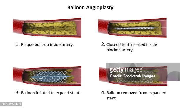 diagram showing procedure of balloon angioplasty. - balloon catheter stock illustrations