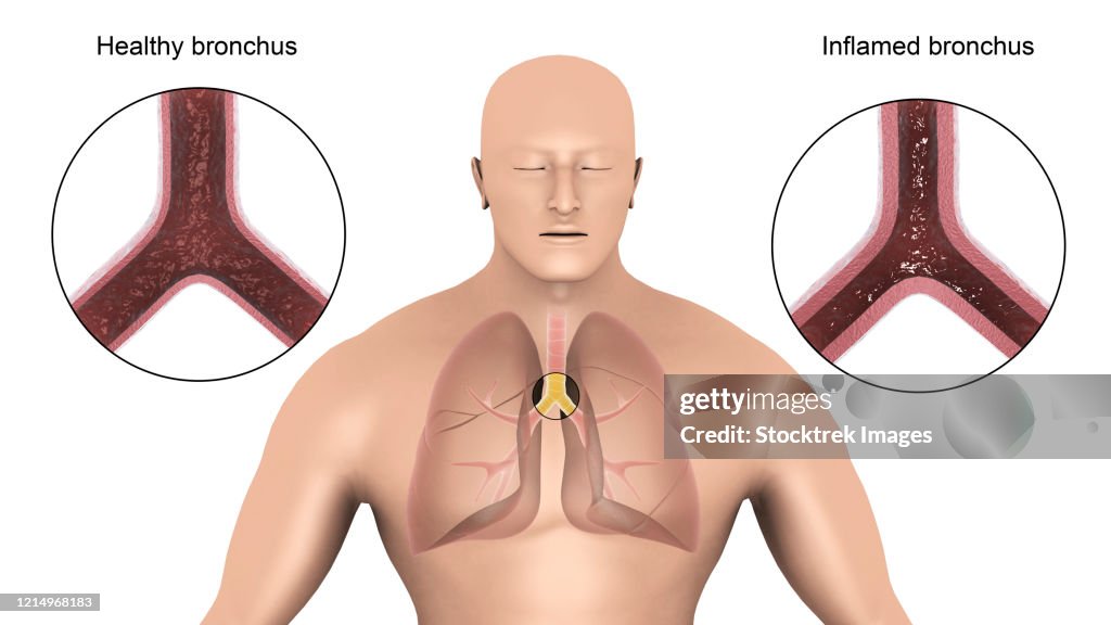 Bronke Medical Illustration Showing Bronchitis In Human Lungs High-Res Vector ...