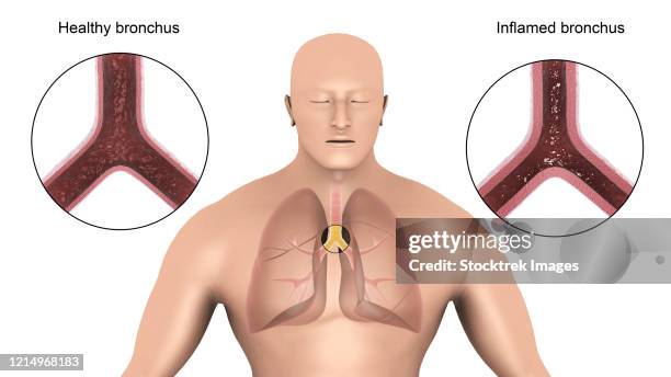 Bronchitis Example Bronchitis Diagram Photos and Premium High Res Pictures - Getty Images