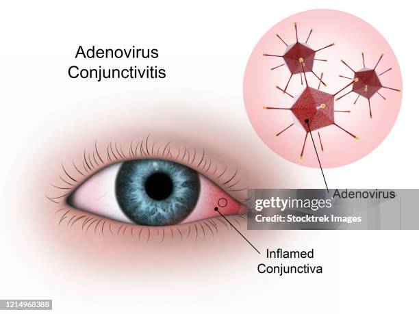 ilustraciones, imágenes clip art, dibujos animados e iconos de stock de viral conjunctivitis in the eye, caused by the adenovirus. - ojos rojos