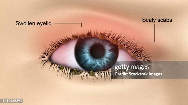 ilustraciones, imágenes clip art, dibujos animados e iconos de stock de medical illustration of blepharitis in the human eye. - ojos rojos