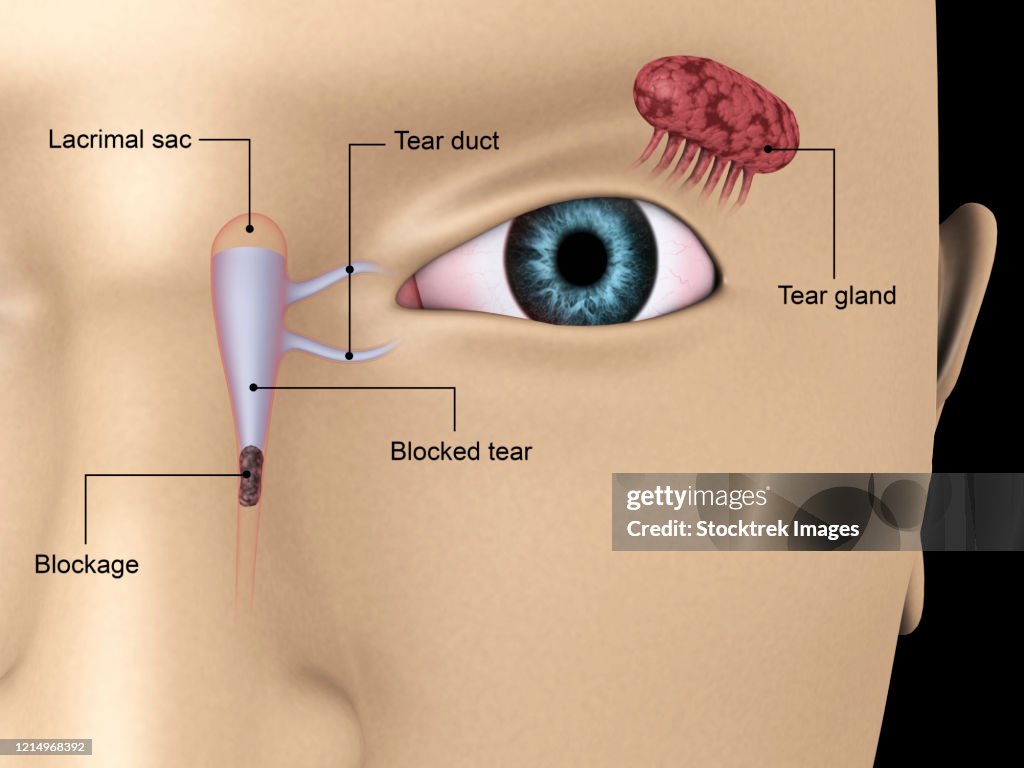 Diagram illustrating blocked tear ducts in the human eye.