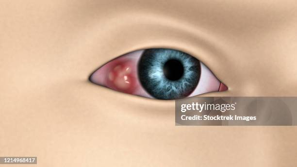 ilustraciones, imágenes clip art, dibujos animados e iconos de stock de medical illustration showing cancer in the eye. - ojos rojos