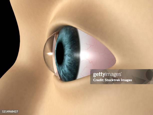 ilustraciones, imágenes clip art, dibujos animados e iconos de stock de medical illustration showing keratoconus in the eye. - ojos rojos