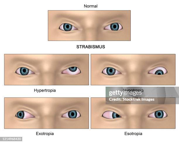 ilustraciones, imágenes clip art, dibujos animados e iconos de stock de strabismus diagram, a condition where the eyes do not properly align with each other. - ojos rojos