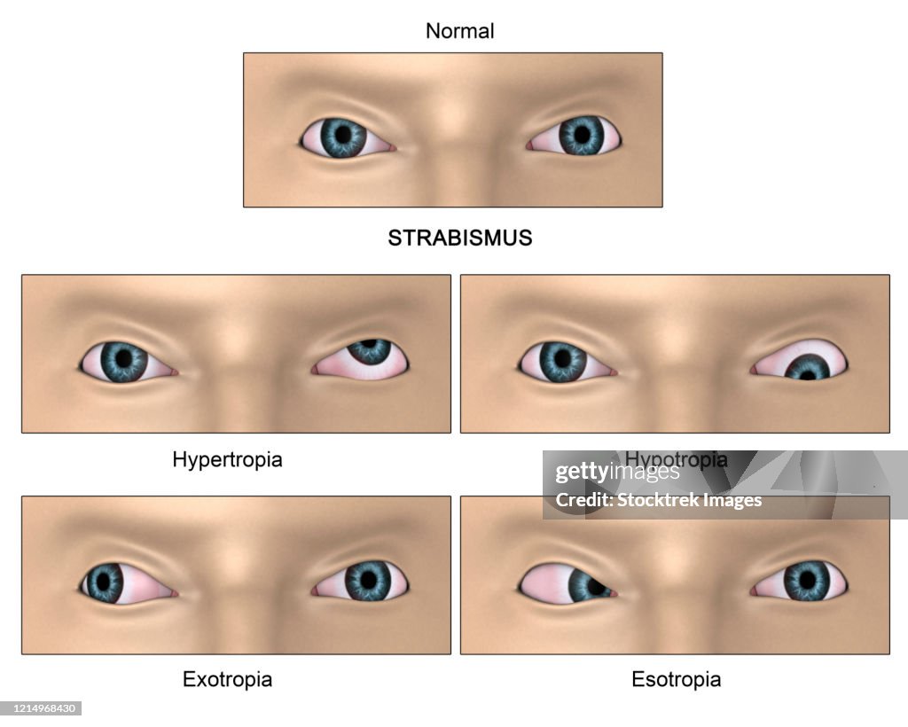 Refractive Strabismus Strabismus Diagram A Condition Where The Eyes Do Not Properly Align ...