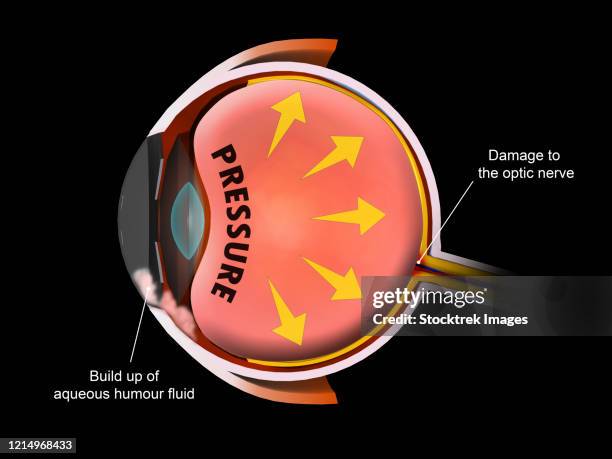 medical illustration showing increased pressure in the eyeball, leading to glaucoma. - glaucoma 幅插畫檔、美工圖案、卡通及圖標