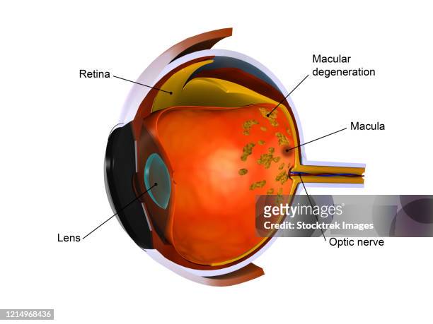 ilustrações, clipart, desenhos animados e ícones de biomedical illustration of macular degeneration. - nervo ótico