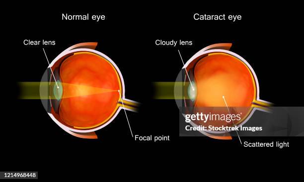 ilustraciones, imágenes clip art, dibujos animados e iconos de stock de medical illustration of a cataract in the human eye, compared to a normal eye. - ojos rojos