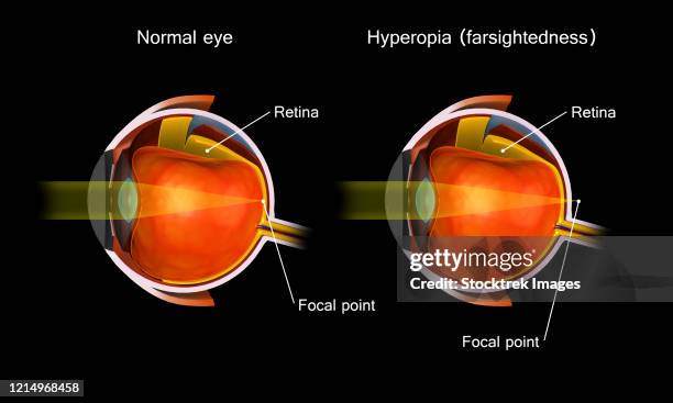 comparison of a normal eye and an eye with hyperopia. - retina stock illustrations