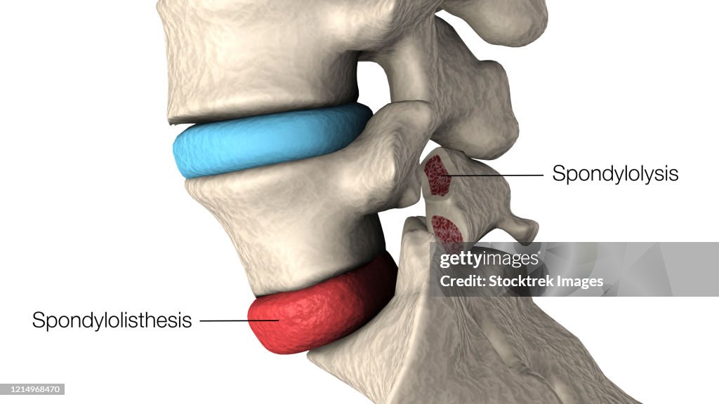 Illustration highlighting spondylolisthesis and spondylolysis in the human vertebra.