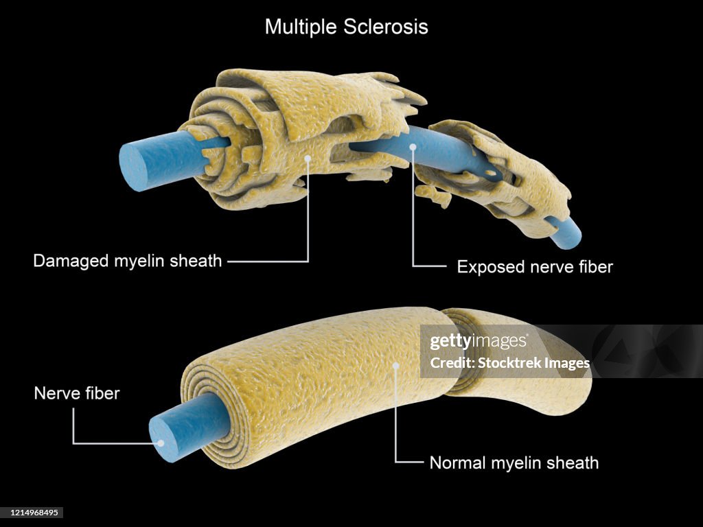 Multiple sclerosis neuron compared to a normal neuron.