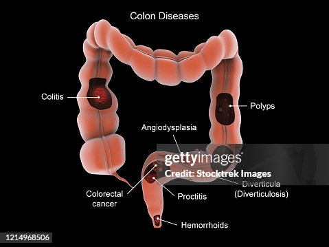 Patho Colon Medical Illustration Showing Types Of Colon Diseases High-Res Vector ...