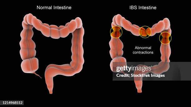 normal vs. abnormal contractions associated with irritable bowel syndrome in the human intestines. - digestive problems stock illustrations
