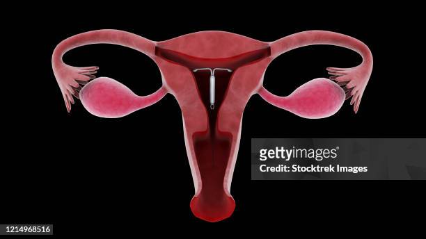 biomedical illustration of an intrauterine device in position inside the female uterus. - iud stock illustrations