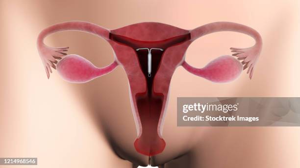 ilustraciones, imágenes clip art, dibujos animados e iconos de stock de biomedical illustration of an intrauterine device in position inside the female uterus. - trompas de falopio