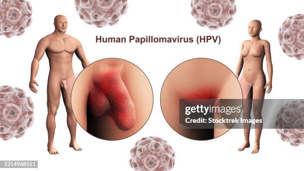 bildbanksillustrationer, clip art samt tecknat material och ikoner med the human papillomavirus infection (hpv infection) in the male and female genitals. - genitals