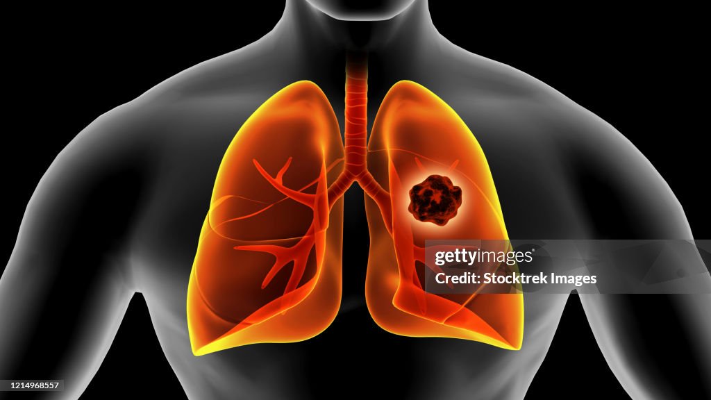 Medical illustration of lung cancer inside the human lungs.