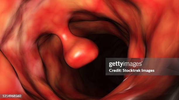 illustrative close-up of a colon polyp. - colon polyp stock illustrations