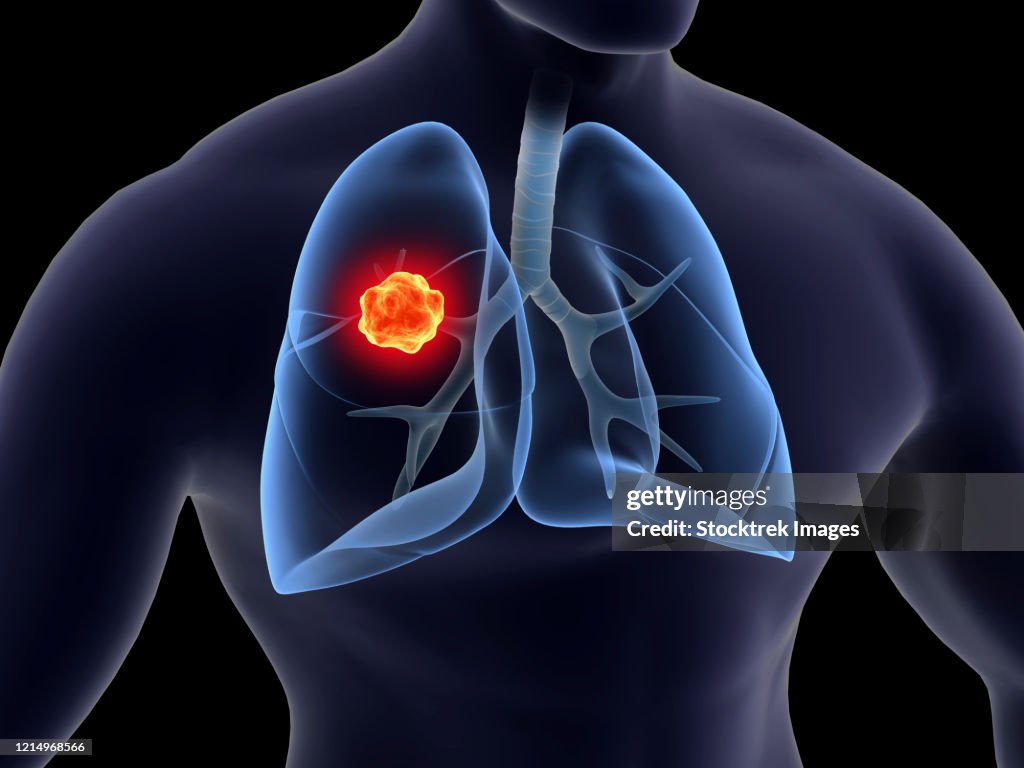 Medical illustration of lung cancer inside the human lungs.