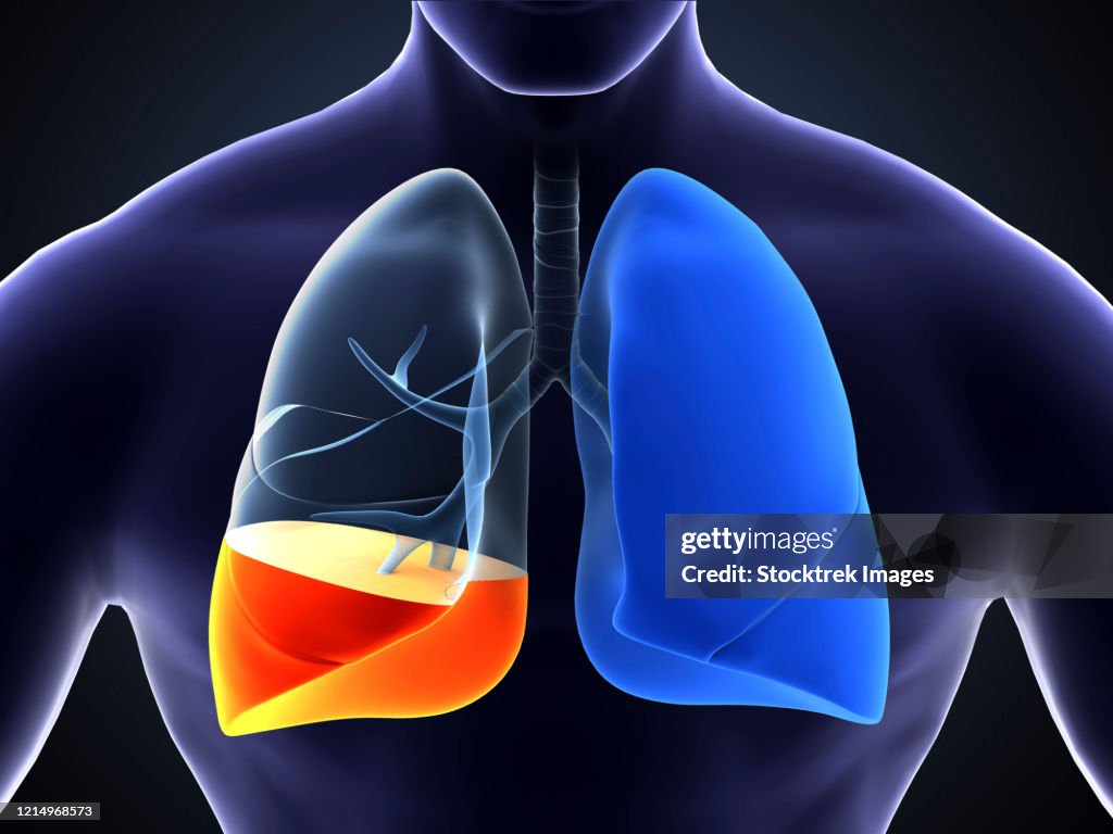 Medical illustration showing pneumonia in the human lungs.