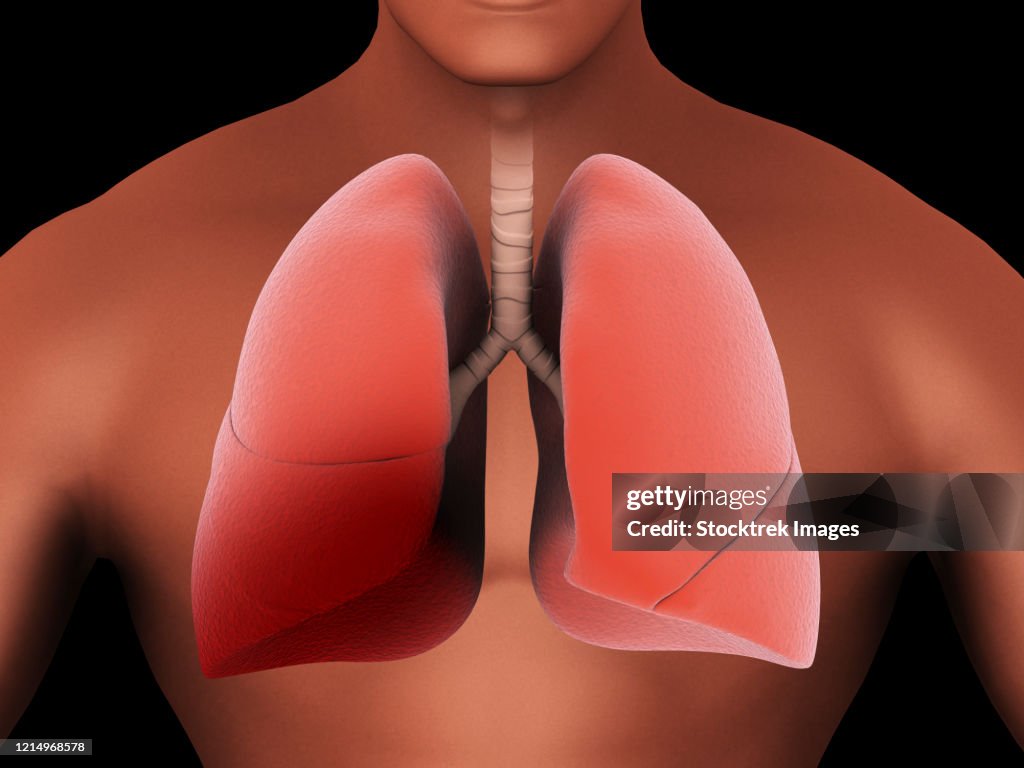 Inflammation in the human lungs caused by pneumonia.