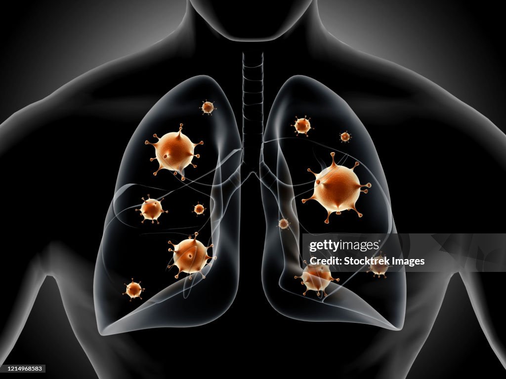 Medical illustration showing pneumonia in the human lungs.