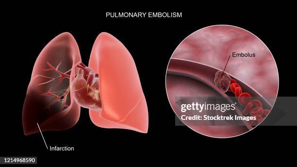 illustrations, cliparts, dessins animés et icônes de medical concept showing pulmonary embolism in the human lungs. - necrose
