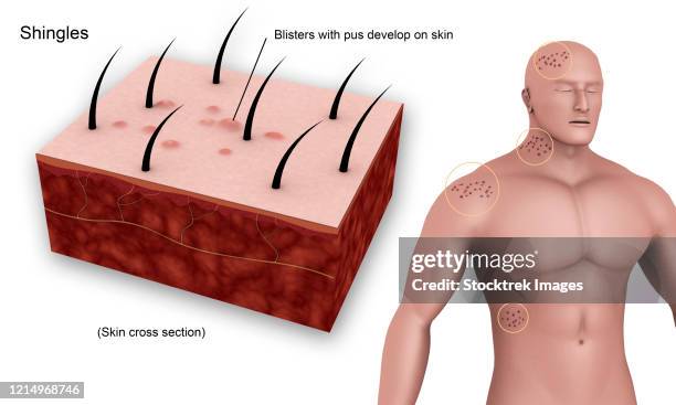 medical diagram showing shingles caused by the varicella-zoster virus. - varicella zoster virus stock illustrations