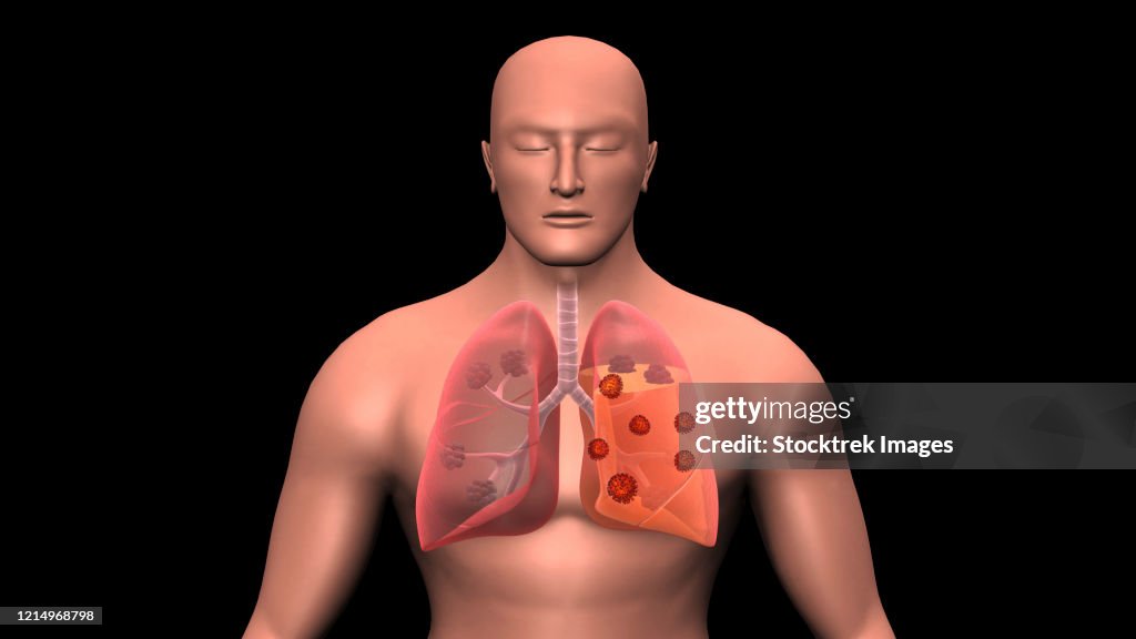 COVID-19 coronavirus infecting the human lungs.
