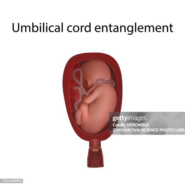 umbilical cord entanglement, illustration - umbilical cord stock-grafiken, -clipart, -cartoons und -symbole