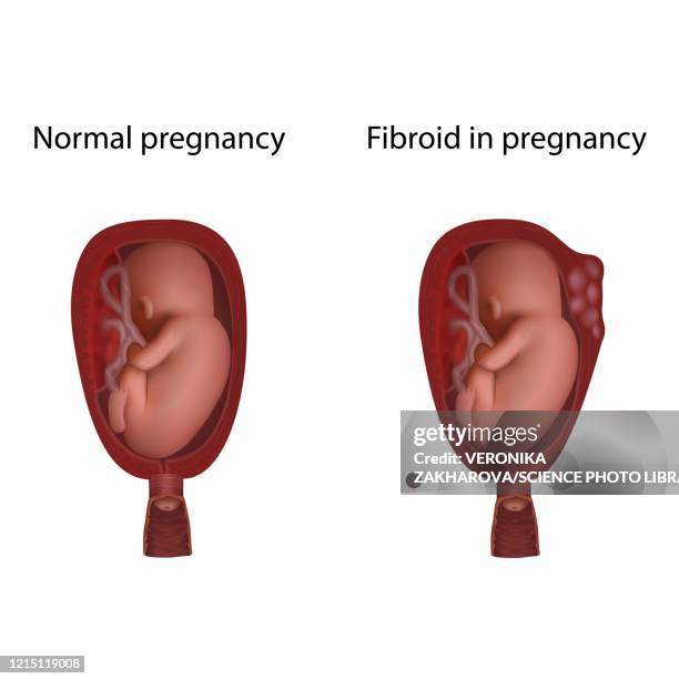 stockillustraties, clipart, cartoons en iconen met fibroid in pregnancy and normal pregnancy, illustration - fibroids