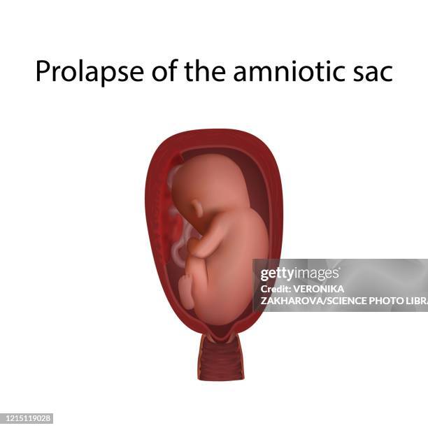 prolapse of the amniotic sac, illustration - prolapsed uterus 幅插畫檔、美工圖案、卡通及圖標