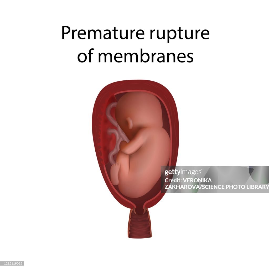 Preterm Prom Premature Rupture Of Membranes Illustration High-Res Vector Graphic ...