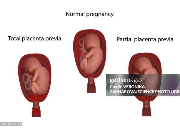 ilustraciones, imágenes clip art, dibujos animados e iconos de stock de health, partial and total placenta previa, illustration - placenta