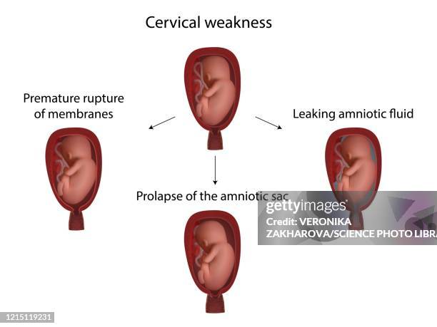 cervical weakness complications, illustration - prolapsed uterus stock illustrations