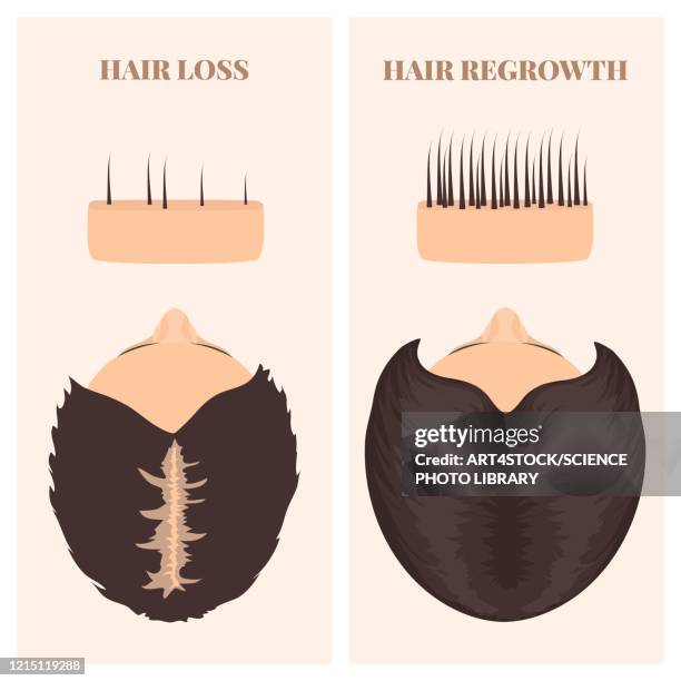 ilustraciones, imágenes clip art, dibujos animados e iconos de stock de woman before and after hair transplantation, illustration - human scalp