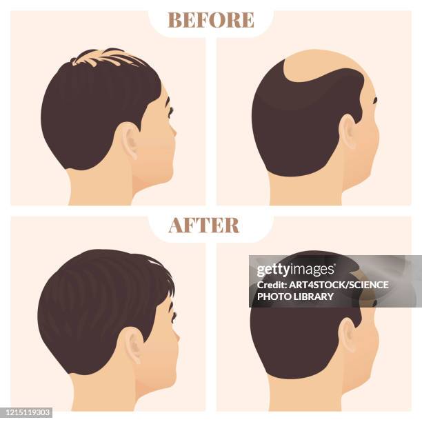 hair loss treatment result in men and women, illustration - adult stock illustrations点のイラスト素材／クリップアート素材／マンガ素材／アイコン素材