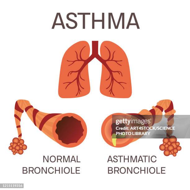 normal and asthmatic bronchioles, illustration - bronchial asthma stock-grafiken, -clipart, -cartoons und -symbole