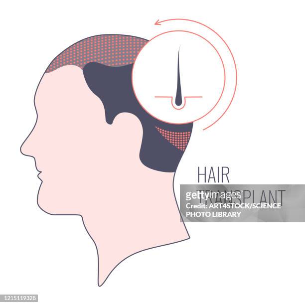 ilustraciones, imágenes clip art, dibujos animados e iconos de stock de hair transplantation in men, conceptual illustration - human scalp
