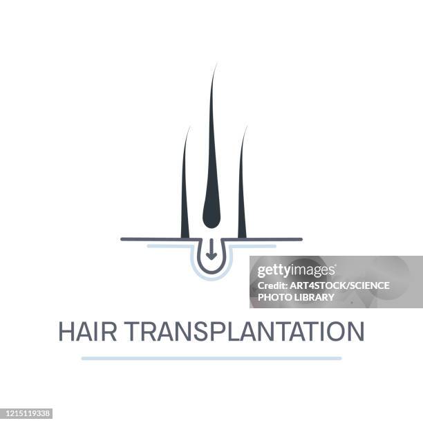 ilustraciones, imágenes clip art, dibujos animados e iconos de stock de hair transplantation, conceptual illustration - reemplazo