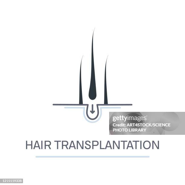 ilustrações, clipart, desenhos animados e ícones de hair transplantation, conceptual illustration - human scalp