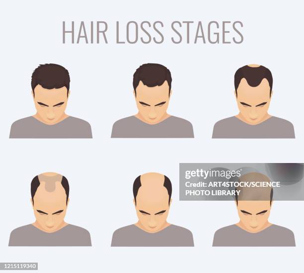 male-pattern baldness stages, illustration - glatzenbildung stock-grafiken, -clipart, -cartoons und -symbole