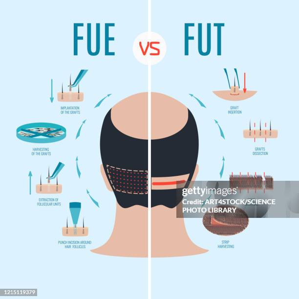 ilustraciones, imágenes clip art, dibujos animados e iconos de stock de fue and fut hair loss treatments comparison, illustration - human scalp