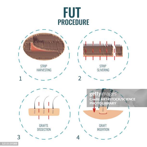 fut hair transplantation stages, illustration - cuticle stock illustrations