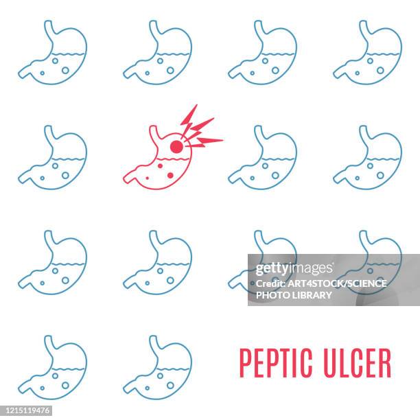 peptic ulcer stomach, conceptual illustration - abdomen surgery stock illustrations