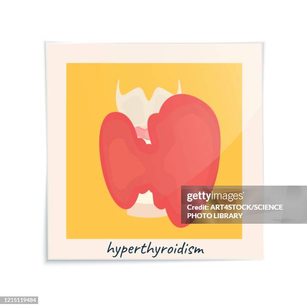 Hyperthyroid Animation Hyperthyroidism Photos and Premium High Res Pictures - Getty Images